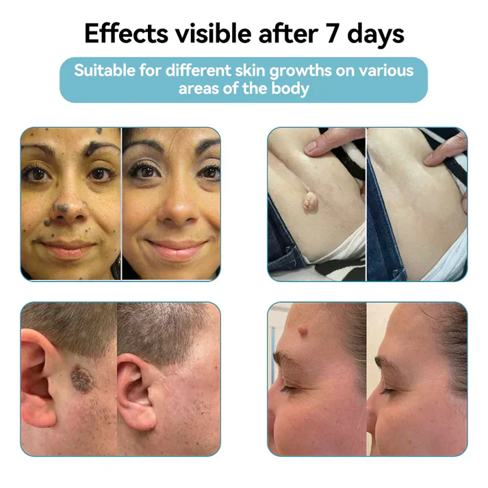 Xalnora™ All-in-One CO₂ Laser Eraser Pen | Removes Moles, Warts, Skin Flaws & Pigmentation