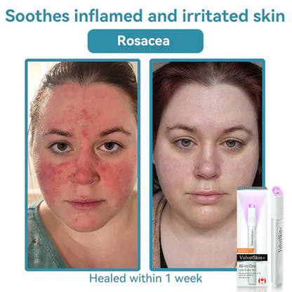 Xalnora™ All-in-One CO₂ Laser Eraser Pen | Removes Moles, Warts, Skin Flaws & Pigmentation