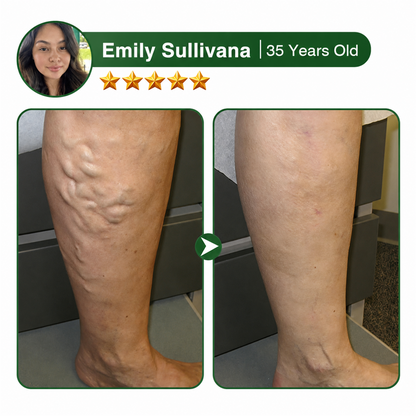🇺🇸🏆Flash Sale 5K+ SOLD!✨7-in-1 Microneedle Vein & Lipedema Treatment Patch
