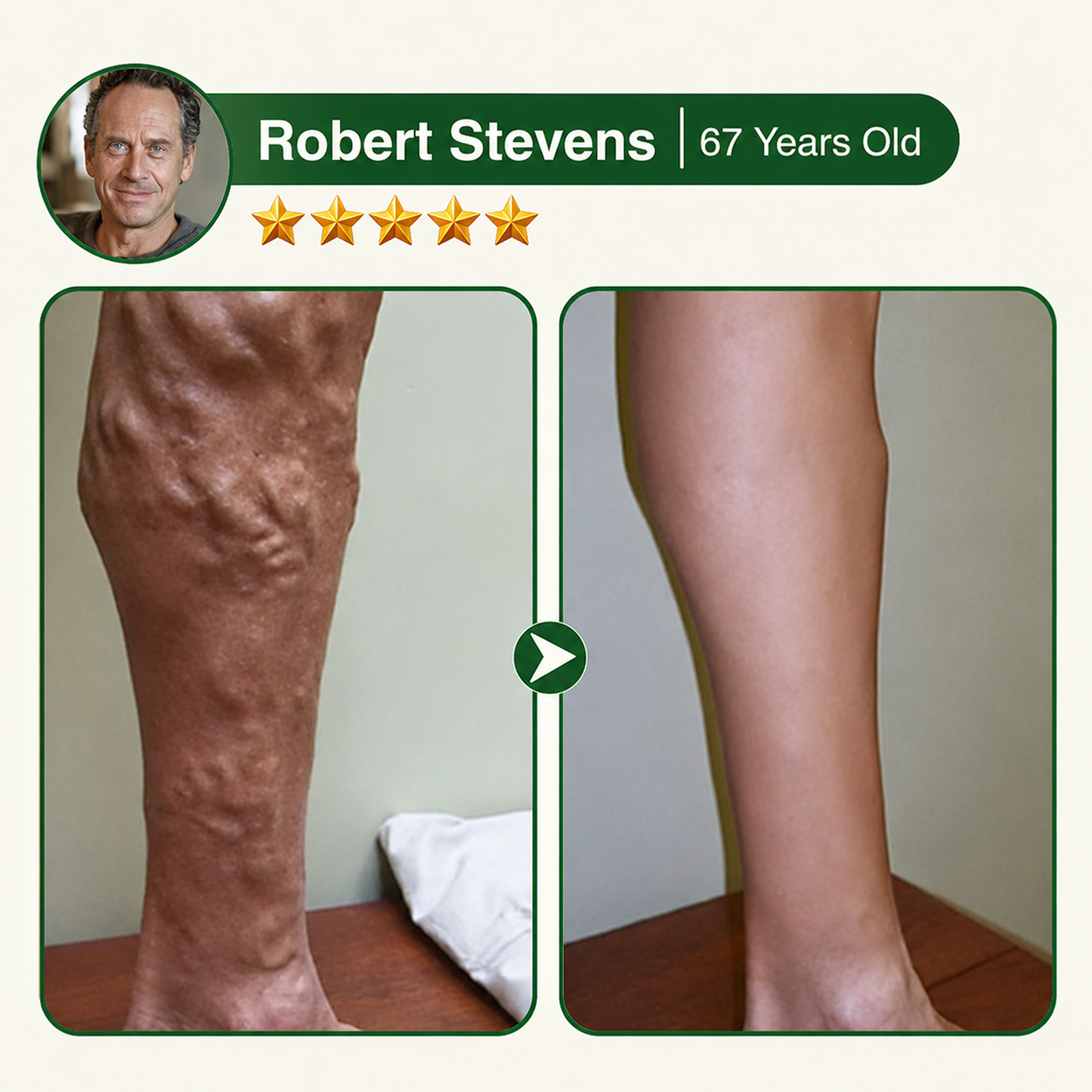 🇺🇸🏆Flash Sale 5K+ SOLD!✨7-in-1 Microneedle Vein & Lipedema Treatment Patch