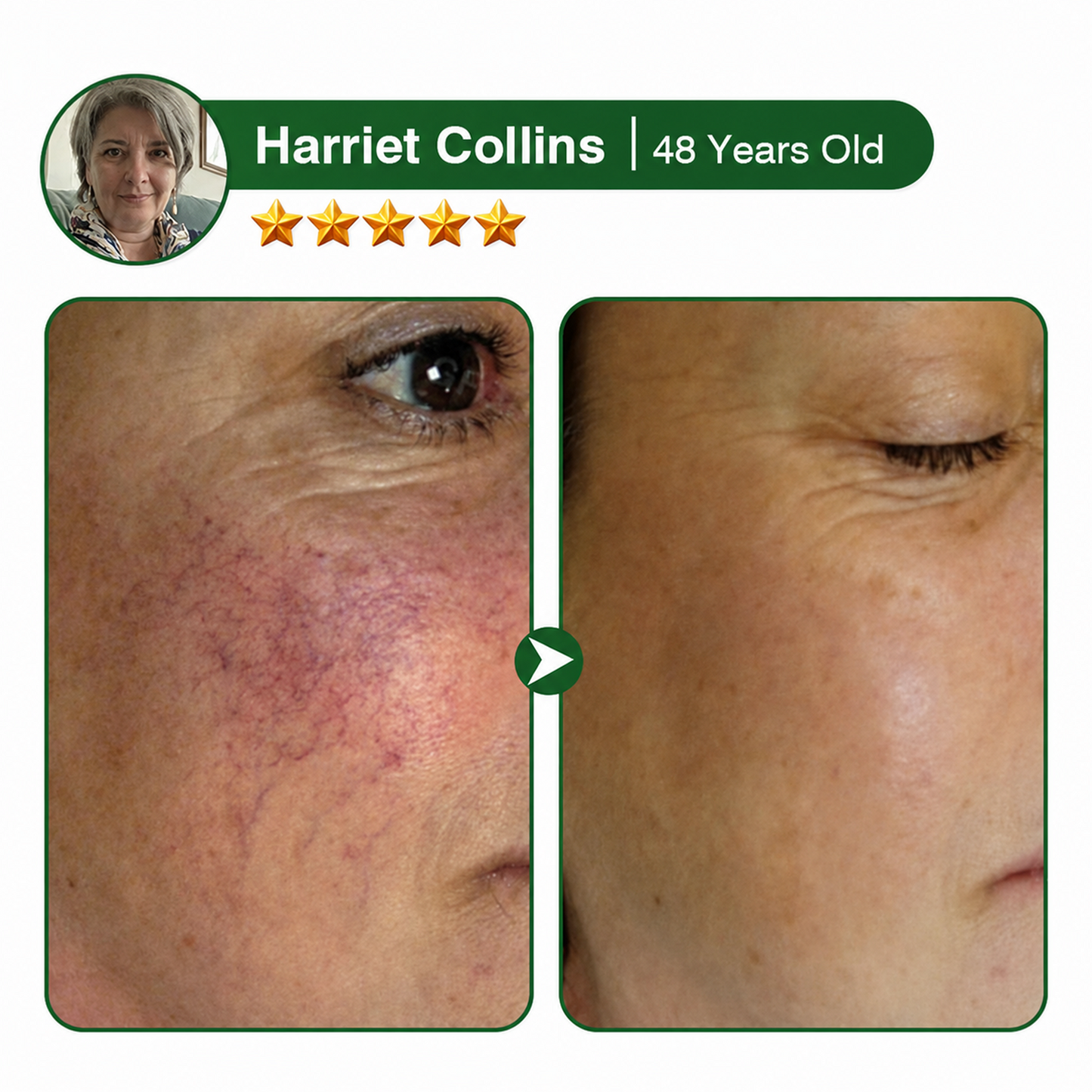🇺🇸🏆Flash Sale 5K+ SOLD!✨7-in-1 Microneedle Vein & Lipedema Treatment Patch