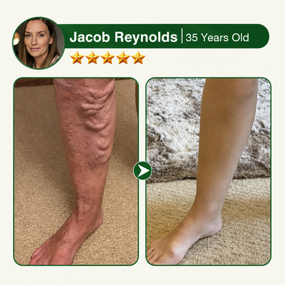 🇺🇸🏆Flash Sale 5K+ SOLD!✨7-in-1 Microneedle Vein & Lipedema Treatment Patch