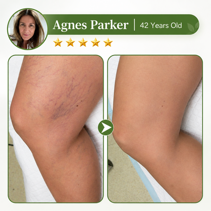 🇺🇸🏆Flash Sale 5K+ SOLD!✨7-in-1 Microneedle Vein & Lipedema Treatment Patch