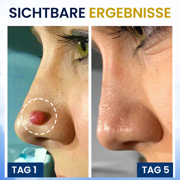 AEXZR® Hautanhängsel Kryo-Behandlungsspray Spray: Schnelle Entfernung von Warzen & Hornhaut – 7 Tage sichtbare Ergebnisse ✨